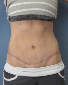 Abdominoplasty (Tummy Tuck) Before and After Pictures