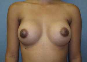 Breast Augmentation Before and After Pictures