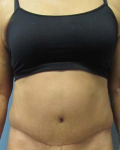 Abdominoplasty (Tummy Tuck) Before and After Pictures