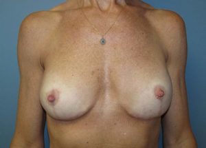 Breast Implant Revision Before and After Pictures