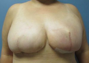 Breast Reconstruction Before and After Pictures