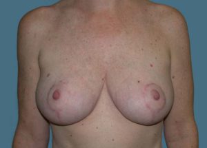 Breast Reduction Before and After Pictures