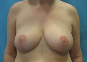 Breast Reduction Before and After Pictures