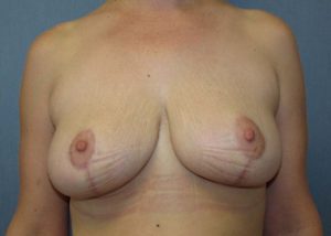 Breast Reduction Before and After Pictures