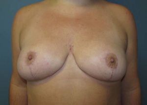 Breast Reduction Before and After Pictures