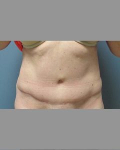 Abdominoplasty (Tummy Tuck) Before and After Pictures