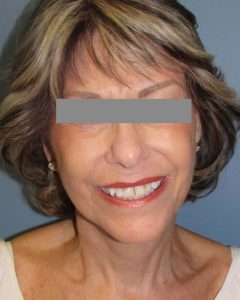 Facelift Before and After Pictures