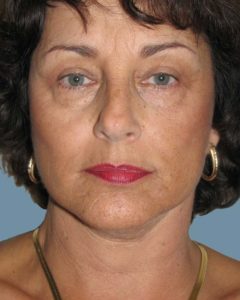 Facelift Before and After Pictures