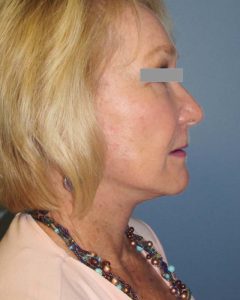 Facelift Before and After Pictures