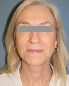 Facelift Before and After Pictures