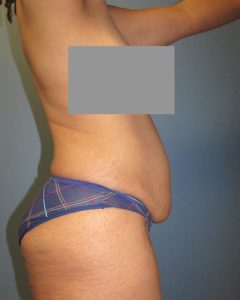 Abdominoplasty (Tummy Tuck) Before and After Pictures