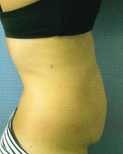 Abdominoplasty (Tummy Tuck) Before and After Pictures