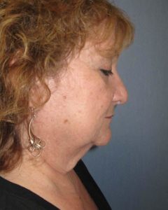 Facelift Before and After Pictures