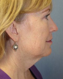 Facelift Before and After Pictures