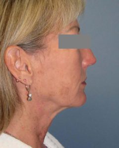 Facelift Before and After Pictures