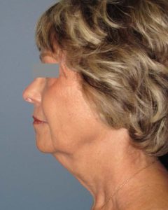 Facelift Before and After Pictures