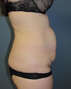Abdominoplasty (Tummy Tuck) Before and After Pictures