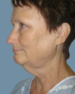 Facelift Before and After Pictures