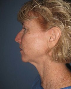 Facelift Before and After Pictures