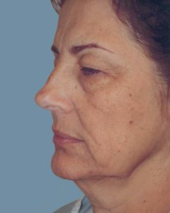 Facelift Before and After Pictures