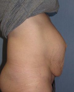 Abdominoplasty (Tummy Tuck) Before and After Pictures