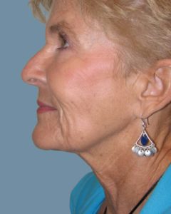 Facelift Before and After Pictures