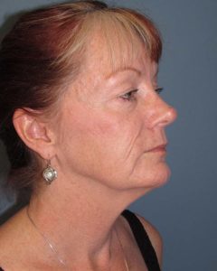 Facelift Before and After Pictures