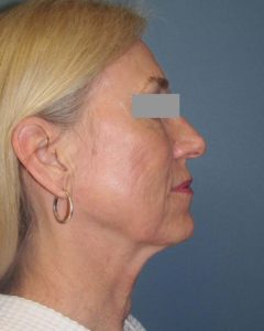 Facelift Before and After Pictures