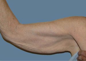 Brachioplasty (Arm Lift) Before and After Pictures