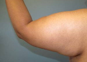 Brachioplasty (Arm Lift) Before and After Pictures