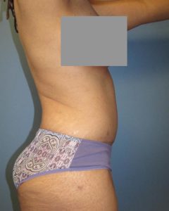 Abdominoplasty (Tummy Tuck) Before and After Pictures