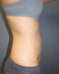 Abdominoplasty (Tummy Tuck) Before and After Pictures