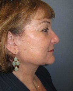 Facelift Before and After Pictures