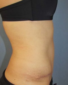 Abdominoplasty (Tummy Tuck) Before and After Pictures
