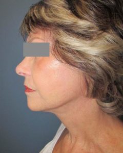 Facelift Before and After Pictures