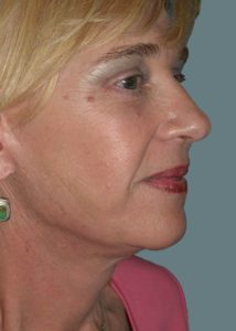 Facelift Before and After Pictures