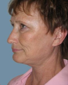Facelift Before and After Pictures