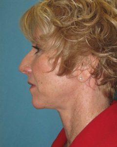 Facelift Before and After Pictures