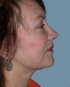 Facelift Before and After Pictures