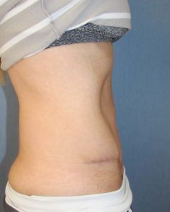 Abdominoplasty (Tummy Tuck) Before and After Pictures