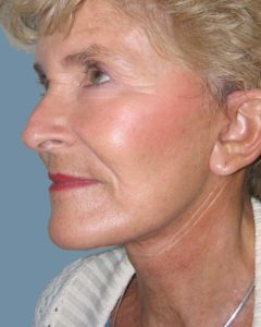 Facelift Before and After Pictures