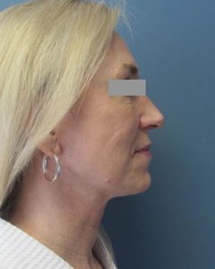 Facelift Before and After Pictures