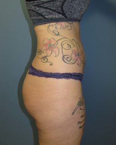 Liposuction Before and After Pictures