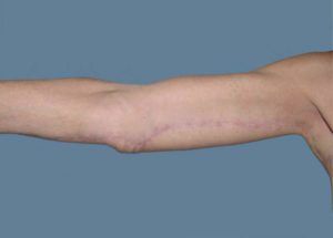 Brachioplasty (Arm Lift) Before and After Pictures