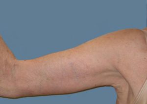 Brachioplasty (Arm Lift) Before and After Pictures