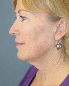 Facelift Before and After Pictures