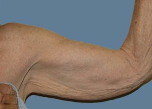 Brachioplasty (Arm Lift) Before and After Pictures