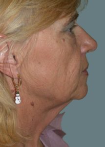 Facelift Before and After Pictures