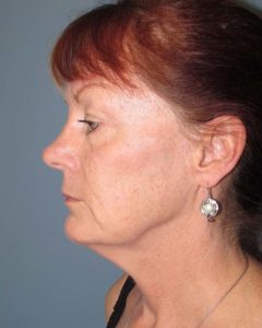 Facelift Before and After Pictures