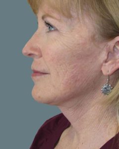 Facelift Before and After Pictures